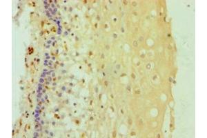 Immunohistochemistry of paraffin-embedded human cervical cancer using ABIN7144985 at dilution of 1:100 (DDX3X antibody  (AA 1-220))