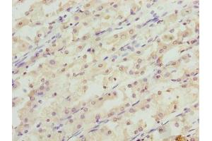 Immunohistochemistry of paraffin-embedded human gastric cancer using ABIN7166006 at dilution of 1:100 (RER1 antibody  (AA 85-139))