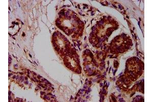 IHC image of ABIN7168291 diluted at 1:400 and staining in paraffin-embedded human breast cancer performed on a Leica BondTM system.