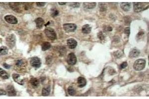Immunohistochemistry (IHC) analyzes of FoxO3 antibody in paraffin-embedded human breast carcinoma tissue. (FOXO3 antibody)