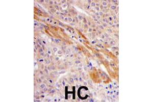 Formalin-fixed and paraffin-embedded human hepatocellular carcinoma reacted with PGK1 polyclonal antibody  , which was peroxidase-conjugated to the secondary antibody, followed by DAB staining.