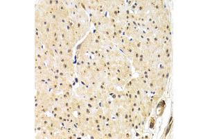 Immunohistochemistry of paraffin-embedded human gastric cancer using TERF1 antibody. (TRF1 antibody)