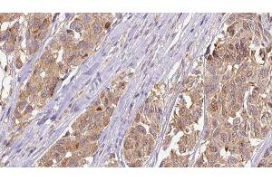 ABIN6275304 at 1/100 staining Human Melanoma tissue by IHC-P. (Neuromedin U antibody  (C-Term))
