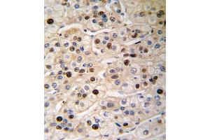 Formalin-fixed and paraffin-embedded human hepatocarcinoma tissue reacted with PCNA antibody (Center) (ABIN389345 and ABIN2839454) , which was peroxidase-conjugated to the secondary antibody, followed by DAB staining.