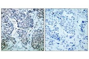 Immunohistochemical analysis of paraffin-embedded human breast carcinoma tissue using SEK1/MKK4(Phospho-Thr261) Antibody(left) or the same antibody preincubated with blocking peptide(right). (MAP2K4 antibody  (pThr261))