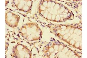 Immunohistochemistry of paraffin-embedded human colon cancer using ABIN7154300 at dilution of 1:100 (GOLPH3L antibody  (AA 6-285))