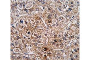 IHC analysis of FFPE human hepatocarcinoma tissue stained with BMPR2 antibody (BMPR2 antibody  (AA 28-59))
