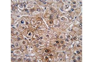 IHC analysis of FFPE human hepatocarcinoma tissue stained with BMPR2 antibody (BMPR2 antibody  (AA 28-59))