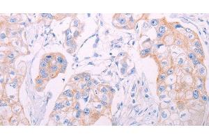 Immunohistochemistry of paraffin-embedded Human breast cancer tissue using ADAMTS14 Polyclonal Antibody at dilution 1:50 (ADAMTS14 antibody)