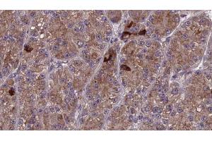 ABIN6273987 at 1/100 staining Human liver cancer tissue by IHC-P. (OR3A1 antibody)