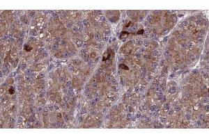 ABIN6273987 at 1/100 staining Human liver cancer tissue by IHC-P. (OR3A1 antibody)