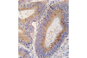 Formalin-fixed and paraffin-embedded human colon carcinoma tissue reacted with GDF11 antibody (N-term) (ABIN388814 and ABIN2839133) , which was peroxidase-conjugated to the secondary antibody, followed by DAB staining. (GDF11 antibody  (N-Term))