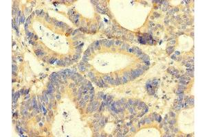 Immunohistochemistry of paraffin-embedded human colon cancer using ABIN7144028 at dilution of 1:100 (Amphiregulin antibody  (AA 107-148))