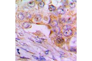 Immunohistochemical analysis of Caspase 6 p18 staining in human lung cancer formalin fixed paraffin embedded tissue section. (Caspase 6 p18 (Center) antibody)