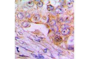 Immunohistochemical analysis of Caspase 6 p18 staining in human lung cancer formalin fixed paraffin embedded tissue section. (Caspase 6 p18 (Center) antibody)
