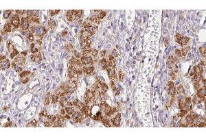 ABIN6278946 at 1/100 staining Human liver cancer tissue by IHC-P. (PLCH2 antibody  (N-Term))