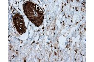 Immunohistochemical staining of paraffin-embedded Adenocarcinoma of colon tissue using anti-ACLY mouse monoclonal antibody. (ACLY antibody)