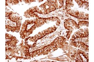 IHC-P Image ME1 antibody detects ME1 protein at cytosol on human ovarian carcinoma by immunohistochemical analysis. (ME1 antibody)