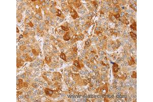 Immunohistochemistry of Human liver cancer using MCM5 Polyclonal Antibody at dilution of 1:40 (MCM5 antibody)