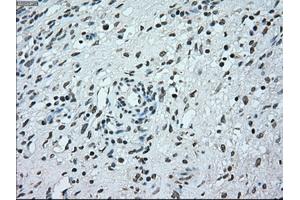 Immunohistochemical staining of paraffin-embedded Adenocarcinoma of breast tissue using anti-BRAF mouse monoclonal antibody. (BRAF antibody)
