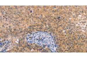 Immunohistochemistry of paraffin-embedded Human cervical cancer tissue using pVHL Polyclonal Antibody at dilution 1:40 (VHL antibody)