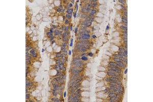 Immunohistochemistry of paraffin-embedded human rectal cancer using MMP25 antibody (ABIN5971552) at dilution of 1/200 (40x lens). (MMP25 antibody)