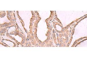 Immunohistochemistry of paraffin-embedded Human thyroid cancer tissue using EEF1D Polyclonal Antibody at dilution of 1:65(x200) (EEF1D antibody)