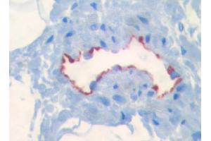 Immunohistochemical staining on paraffin sections of human intestine (border area of a colon carcinoma) using LYVE-1 antibody #ABIN115663 (picture courtesy of Dr. (LYVE1 antibody  (AA 24-231))