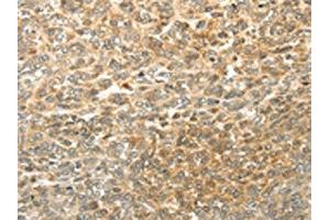 The image on the left is immunohistochemistry of paraffin-embedded Human ovarian cancer tissue using ABIN7130225(MGEA5 Antibody) at dilution 1/20, on the right is treated with fusion protein. (MGEA5 antibody)