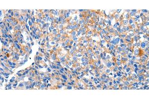 Immunohistochemistry of paraffin-embedded Human breast cancer tissue using HCN2 Polyclonal Antibody at dilution 1:80 (HCN2 antibody)