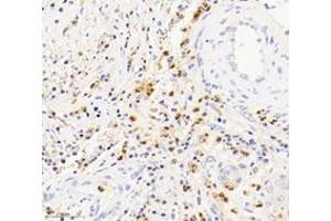 Immunohistochemistry analysis of paraffin-embedded human squamous carcinoma of the cervix using S100A12 (ABIN7075493) at dilution of 1: 4000 (S100A12 antibody)