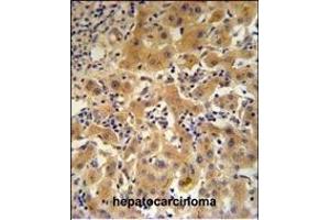CP Antibody (N-term) (ABIN391512 and ABIN2841473) IHC analysis in formalin fixed and paraffin embedded human hepatocarcinoma followed by peroxidase conjugation of the secondary antibody and DAB staining. (Ceruloplasmin antibody  (N-Term))