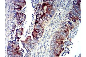 Immunohistochemical analysis of paraffin-embedded rectum cancer tissues using P2RY14 mouse mAb with DAB staining. (P2RY14 antibody)