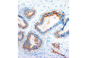 Anti-CXCR4 antibody, IHC(P) IHC(P): Human Mammary Cancer Tissue (CXCR4 antibody  (N-Term))