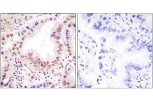 Immunohistochemistry analysis of paraffin-embedded human lung carcinoma tissue, using ETS1 (Ab-38) Antibody.