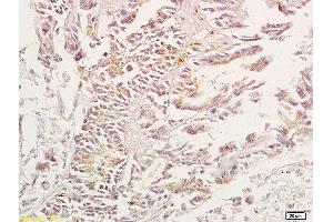 Formalin-fixed and paraffin embedded human gastric carcinoma tissue labeled with Anti-ADORA3 Adenosine A3 Receptor Polyclonal Antibody, unconjugated (ABIN673629) at 1:200, followed by incubation with conjugated secondary antibody and DAB staining (Adenosine A3 Receptor antibody  (AA 85-180))