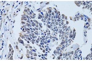 Immunohistochemistry of paraffin-embedded Human lung cancer using SIN3A Polyclonal Antibody at dilution of 1:100 (40x lens). (SIN3A antibody)
