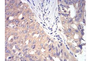 0:Immunohistochemical analysis of paraffin-embedded ovarian cancer tissues using DDX3X mouse mAb with DAB staining. (DDX3X antibody  (AA 518-661))