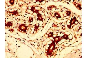 IHC image of ABIN7143738 diluted at 1:300 and staining in paraffin-embedded human breast cancer performed on a Leica BondTM system. (FUT8 antibody  (AA 247-377))