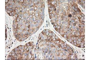 Immunohistochemical staining of paraffin-embedded Adenocarcinoma of Human breast tissue using anti-TUBB4 mouse monoclonal antibody. (TUBB4 antibody)