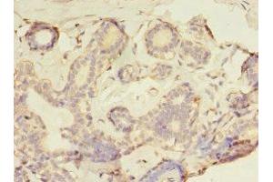 Immunohistochemistry of paraffin-embedded human breast cancer using ABIN7153932 at dilution of 1:100