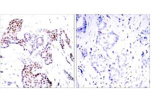 Immunohistochemical analysis of paraffin-embedded human breast carcinoma tissue using Elk-1 (phospho-Ser389) antibody (E011037). (ELK1 antibody  (pSer389))