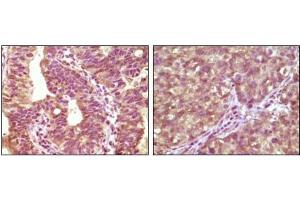 Immunohistochemical analysis of paraffin-embedded human bladder carcinoma tissue(left) and lung carcinoma tissue (right) showing cytoplasmic localization using BRAF antibody with DAB staining.