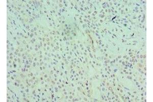 Immunohistochemistry of paraffin-embedded human breast cancer using ABIN7168966 at dilution of 1:100 (SRSF1 antibody  (AA 1-248))