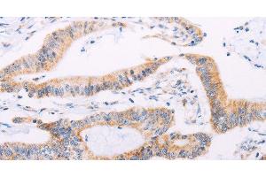 Immunohistochemistry of paraffin-embedded Human colon cancer tissue using ADAMTS16 Polyclonal Antibody at dilution 1:50 (ADAMTS16 antibody)