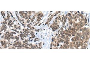 Immunohistochemistry of paraffin-embedded Human thyroid cancer tissue using ZNF83 Polyclonal Antibody at dilution of 1:50(x200) (ZNF83 antibody)