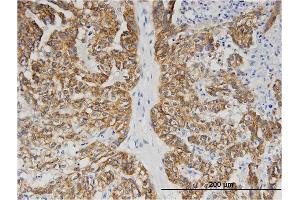Immunoperoxidase of monoclonal antibody to BAIAP2L1 on formalin-fixed paraffin-embedded human ovarian cancer. (BAIAP2L1 antibody  (AA 1-511))