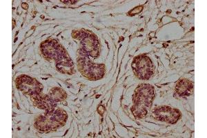 IHC image of ABIN7154793 diluted at 1:100 and staining in paraffin-embedded human breast cancer performed on a Leica BondTM system.