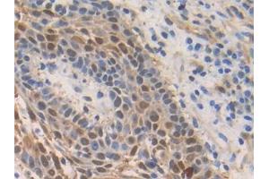 Detection of S100A2 in Human Skin cancer Tissue using Polyclonal Antibody to S100 Calcium Binding Protein A2 (S100A2) (S100A2 antibody  (AA 2-98))
