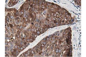 Immunohistochemical staining of paraffin-embedded Adenocarcinoma of Human breast tissue using anti-OSBP mouse monoclonal antibody. (OSBP antibody)
